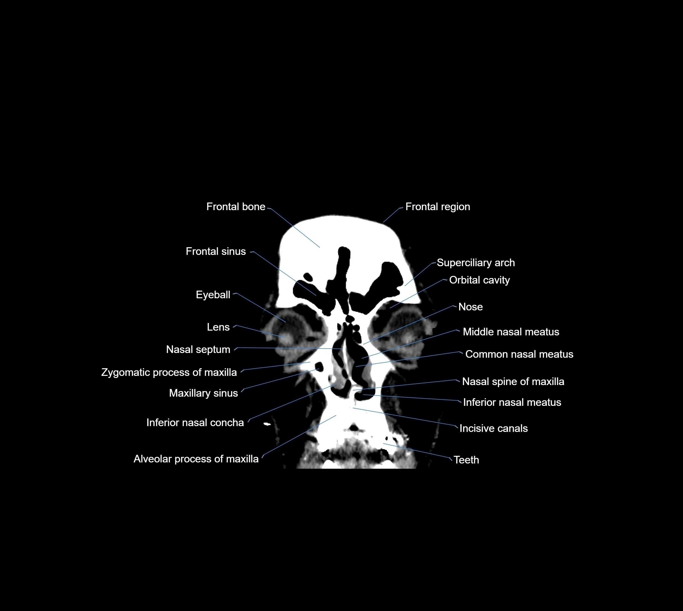 CT Brain coronal cross sectional radiology anatomy image  -img-00001-06.webp